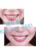 精做假牙：各种烤瓷牙、全瓷牙、美容牙、金属支架、隐形假牙、老