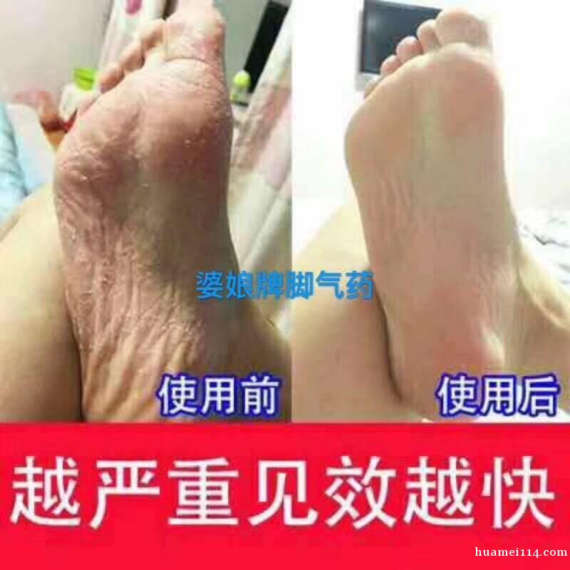 中国纯中药配方,美国FDA已认证【治脚气,鼻炎,狐臭,灰指甲 中国纯中药配方,美国FDA已认证【治脚气,鼻炎,狐臭,灰指甲